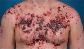 Extreme acne door anabolen tekent bodybuilder (21) voor het leven