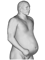 Ascites