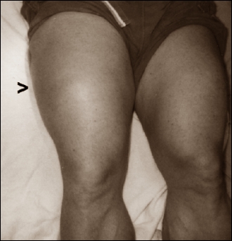 Een quadriceps vol pus