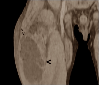 Een quadriceps vol pus