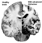 Nu zijn er volgens de World Alzheimer Reports [alz.co.uk] ongeveer 40 miljoen mensen met Alzheimer op deze planeet, maar dat aantal verdubbelt elke 20 jaar. Alzheimer wordt een epidemie. Of die jou gaat treffen hangt voor een belangrijk van jezelf af. Volgens epidemiologen van het Amerikaanse Taub Institute zijn er twee leefstijlfactoren die gezamenlijk je kans op Alzheimer halveren.