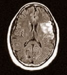 Van de neurologen van Indiana University mag de overheid alle afslanksupplementen met Ephedra uit de schappen halen. De cocktails van thermogene stoffen veroorzaken beroertes met vaak blijvende gevolgen. Dat blijkt uit vijf gevallen die de artsen de afgelopen twee jaar in hun ziekenhuis zagen langskomen.